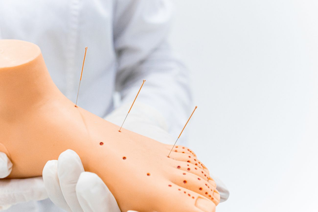 Acupuncture at Parkerhill wellness centre