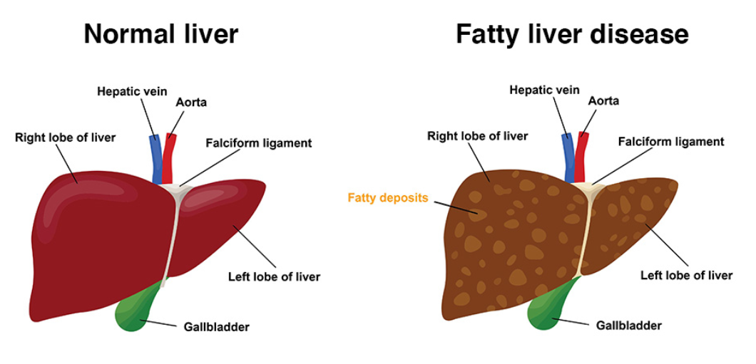 fatty liver